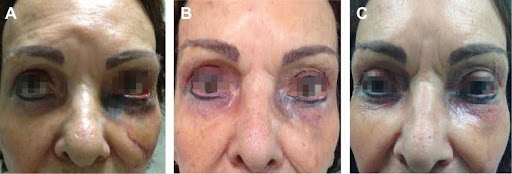 laserchirurgischer Eingriff.jpg