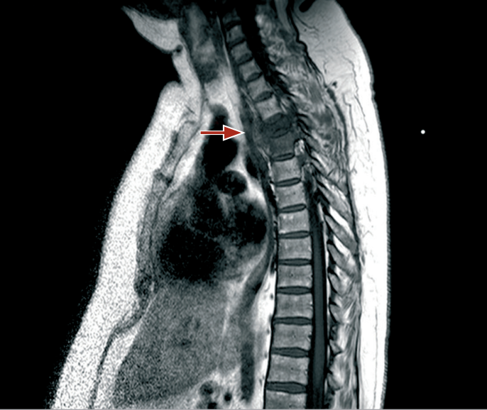 MRI of the spine.png