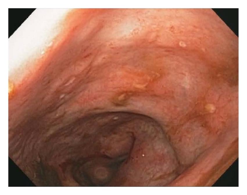 Endoscopic features.png