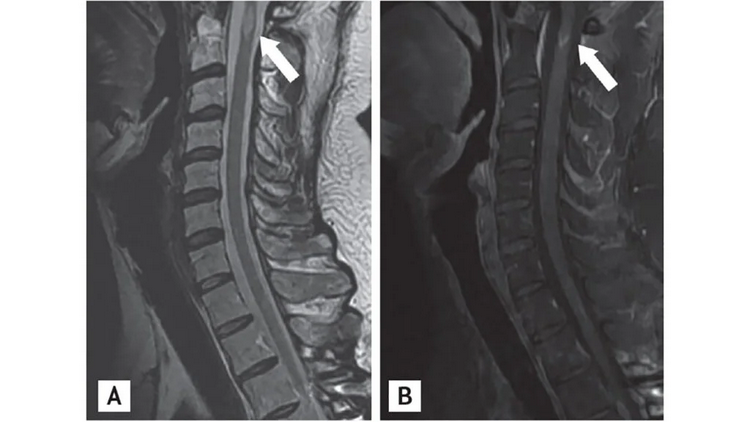 Images of MS Lesions on the ..