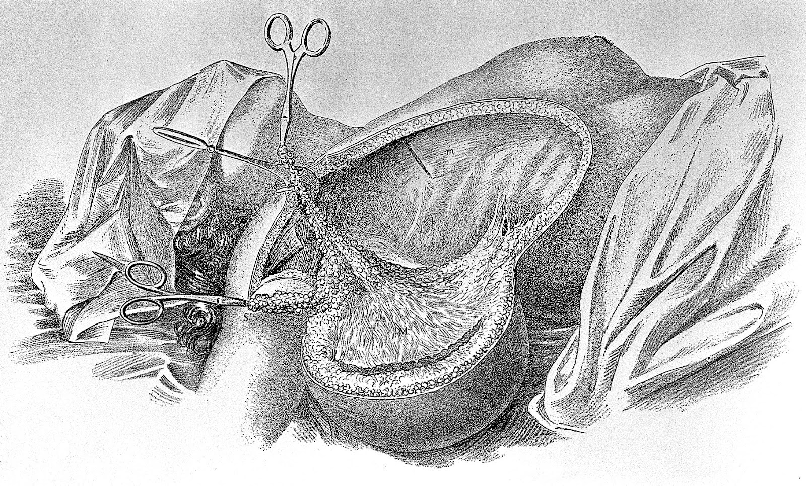 Recent history of Breast Can..